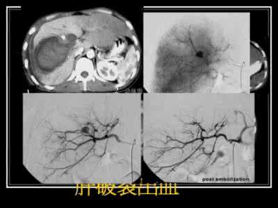 全球肝病最好的医院 弥漫性肝病 弥漫性肝病 这是由什么引起的