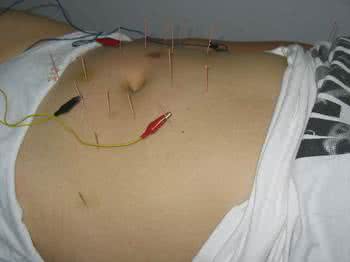 埋线减肥注意事项 针灸埋线减肥 针灸埋线减肥后的注意事项