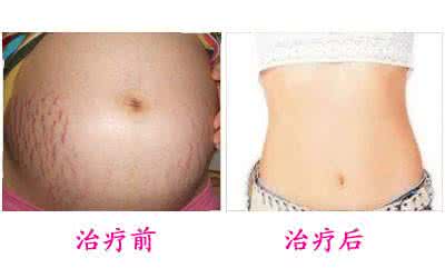 妊娠纹什么时候开始长 什么是妊娠纹?妊娠纹什么时候长?