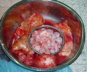 肝包虫预防 肝包虫病 如何预防肝包虫病