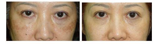 老年斑的产生原因 脸上有老年斑怎么办 老年斑是怎么产生的呢