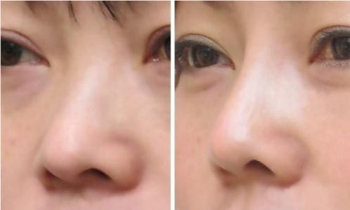 鼻头改小手术 鼻头改小手术 大鼻头改小术的并发症是什么呢