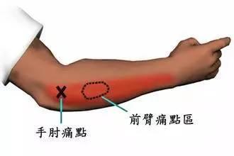 网球肘成因 网球肘成因 网球肘专题（一）—网球肘的概念、成因及临床表现