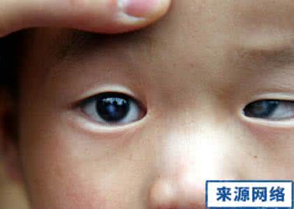 白内障的症状是什么 儿童白内障的症状是什么？