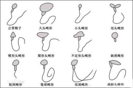 男性精子畸形率高 男性畸形精子症 男性精子畸形率多少才是正常的呢？