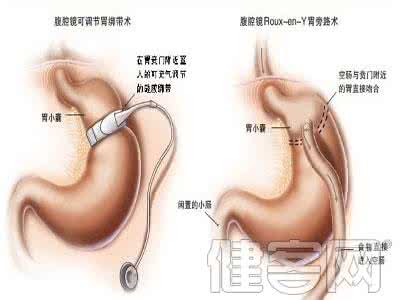 胃癌术后康复 胃癌术后康复 胃癌术后的康复注意