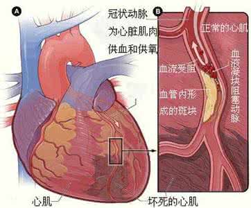 心梗部位心电图 【临床】急性心梗六个常见疼痛部位 ！