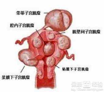 子宫肌瘤会影响月经吗 子宫肌瘤会月经混乱吗？