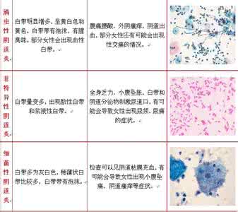 阴道炎有什么症状表现 阴道炎症状表现是什么