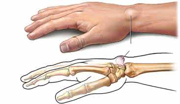 手腕腱鞘炎偏方 治跟骨骨刺 手腕腱鞘炎偏方