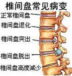 腰突引起坐骨神经痛 绝对秘方（腰突、坐骨神经痛）一副就好？