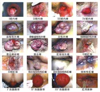 治疗痔疮的食疗方法 治疗痔疮的食疗方法 治疗痔疮的食疗方法介绍