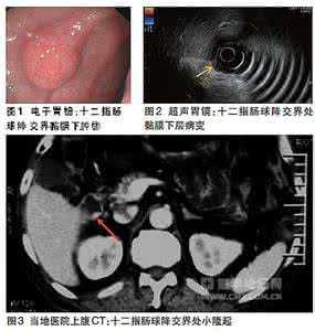 胃泌素瘤症状 胃泌素瘤 胃泌素瘤是什么样的疾病