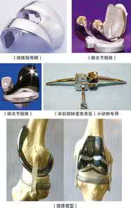 膝关节置换动画演示 骨科微视 | 3D动画演示全膝关节置换术