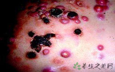 白血病的起因 白血病的起因 中医如何治白血病