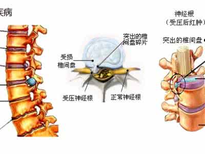 腰椎间盘突出症的治疗 腰椎间盘突出症的治疗有两种选择