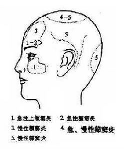 治急慢性鼻窦炎 图文：急慢性鼻炎、鼻窦炎立愈方