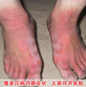 雷诺现象是什么病 雷诺现象 天冷了,有种病叫 “雷诺现象”