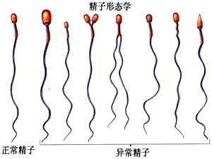 弱畸精子症 弱畸精子症怎么办？