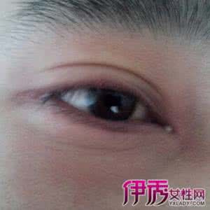 霰粒肿预防 霰粒肿预防 霰粒肿的预防