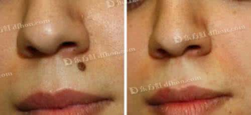 祛痣多少钱 祛痣多少钱 祛痣多少钱？与4因素有关