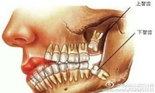 拔智齿第三天疼痛加重 拔智齿第三天疼痛加重 足足痛了三天，可迎来你的那刻，所有疼痛都消失