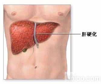 肝脏移植手术费用 肝脏移植 肝脏手术的适应症