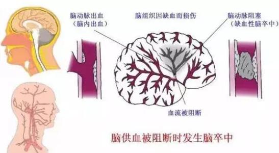 高血压中风怎么治疗 高血压中风 经常被人们当垃圾，竟然可以治中风、高血压、痔疮等多种疾病