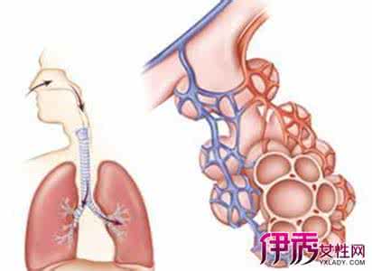 肺积水严重吗怎么治疗 肺积水严重吗 肺积水如何治疗