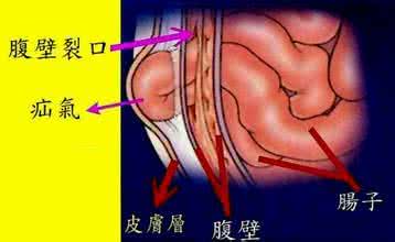 男性疝气治疗方法 男性疝气治疗方法 以下方法帮你摆脱疝气