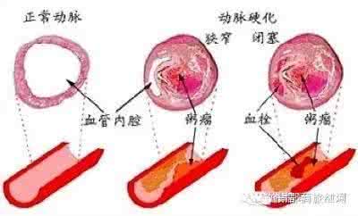 喝什么泡水降血压最好 每天拿「它」泡水喝，降血壓、血管堵塞、腦中風全都不見了，它就是有這麼神奇的功效！