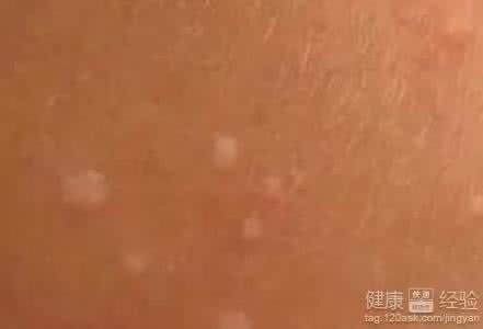传染性软疣怎么根治 传染性软疣怎么治疗 这些方法效果好