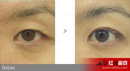 三点埋线双眼皮恢复期 三点埋线双眼皮恢复期 埋线双眼皮的恢复期