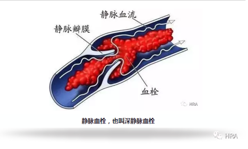 身体有血栓是什么症状 这里的血栓最致命 身体这处血栓最致命!只需一碗粥,降血脂,通血栓!互相传阅~