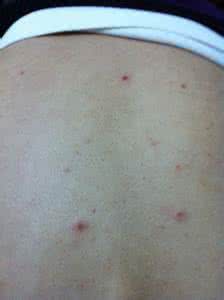 背上长痘痘的原因 背上长痘痘的原因 背上长痘痘怎么办？