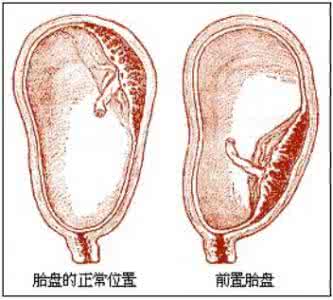 胎盘位于子宫前壁好吗 胎盘位于子宫前壁 胎盘位于子宫前壁是否正常