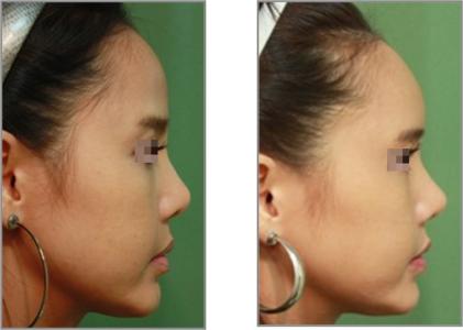 治额头青春痘的方法 隆额头 隆额头的两种主要方法