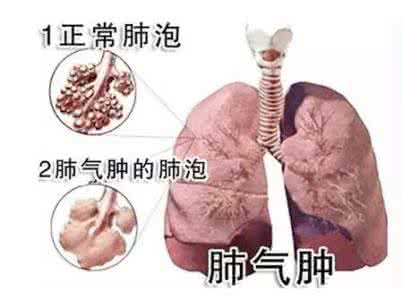 哮喘肺气肿治疗方法 肺气肿好治吗 治疗肺气肿方法是关键