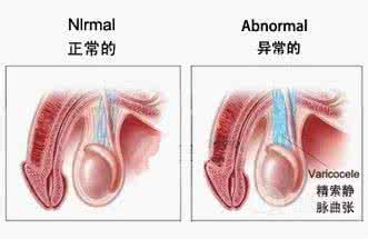 左侧精索静脉曲张原因 左侧精索静脉曲张原因 精索静脉曲张原因 精索静脉曲张怎么治