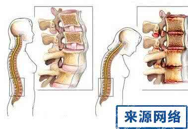 强直性脊柱炎治疗方法 治疗强直性脊柱炎 强直性脊柱炎的治疗方法 五大方法治疗它