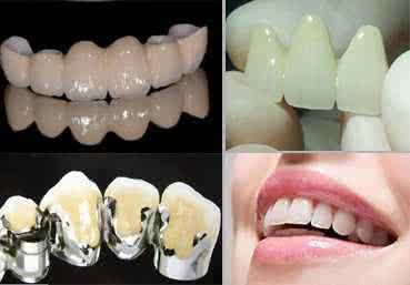 陶瓷牙和烤瓷牙区别 陶瓷牙有几种 烤瓷牙有几种