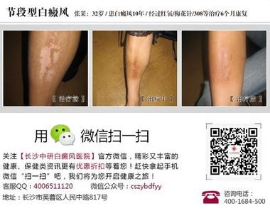 城里人和农村人的区别 城里人和农村人的区别 为什么城里的得白癜风比农村的多