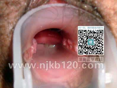 宫颈湿疣怎么治疗 宫颈湿疣基本概述