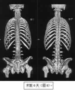 强直性脊椎炎脊柱畸形 强直性脊椎炎脊柱畸形 构建强直性脊柱炎后凸畸形的三维有限元模型