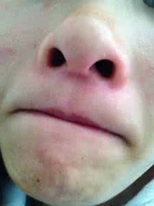 皮肤过敏注意事项 吃什么会皮肤过敏 皮肤过敏的注意事项有什么