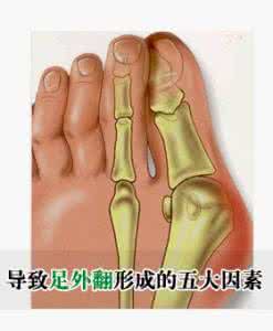 如何预防脚拇指外翻 拇指外翻 拇指外翻如何治疗与预防