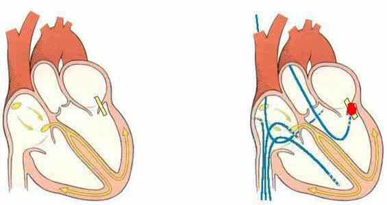 心脏预激综合症严重吗 心脏预激综合症严重吗 警惕心律失常