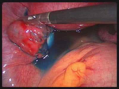 带环怀孕的症状 带环 刚刚怀孕有什么症状