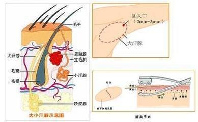 激光除狐臭 激光去狐臭 教你如何让狐臭跑光光