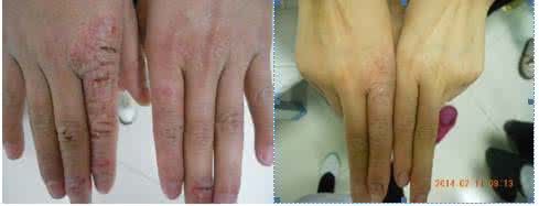 不日即可痊愈 治疗牛皮癣的外用药,而且只需涂抹一次即可痊愈,不复发